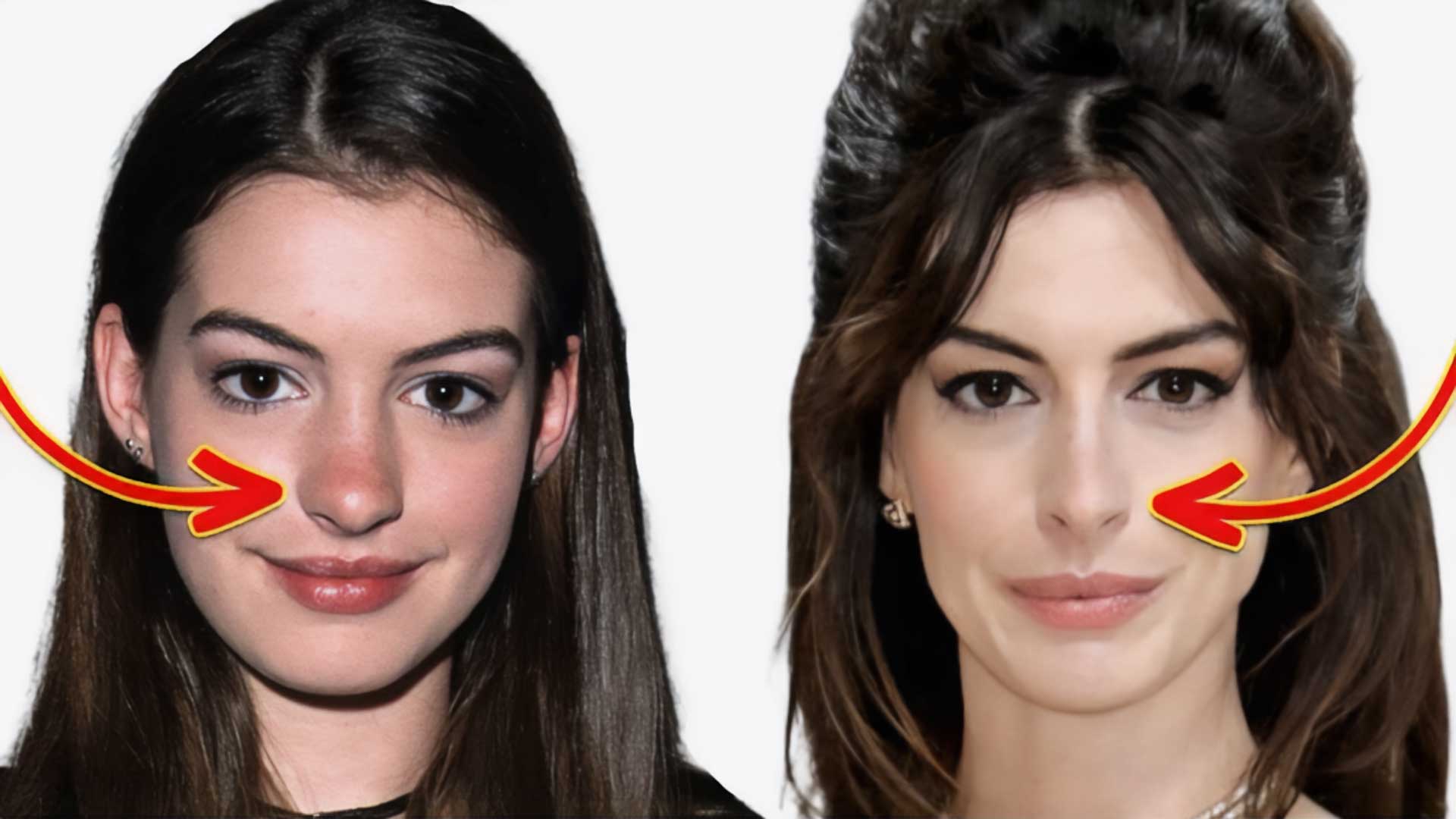 Anne Hathaway plastic surgery