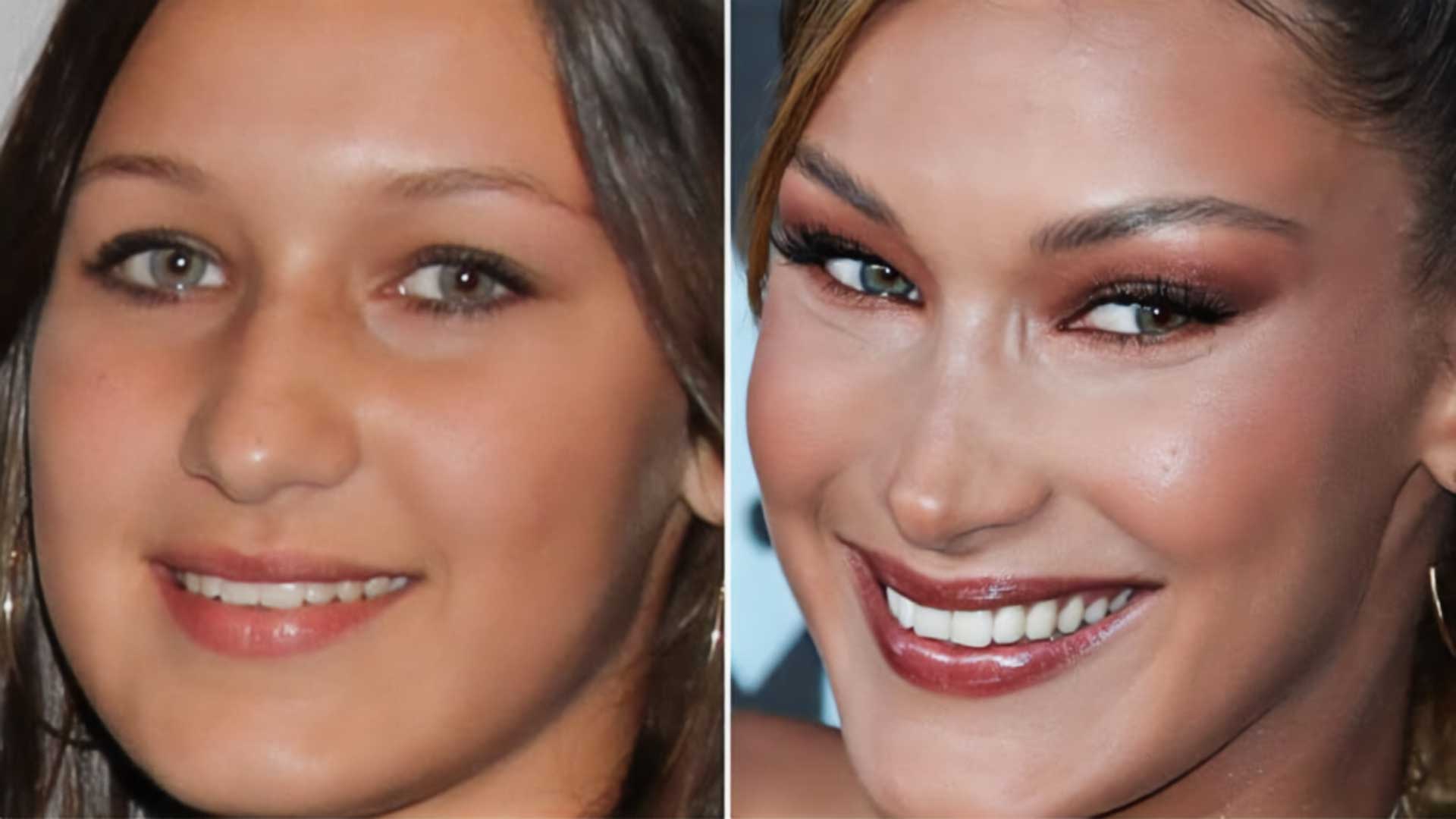 Bella Hadid plastic surgery