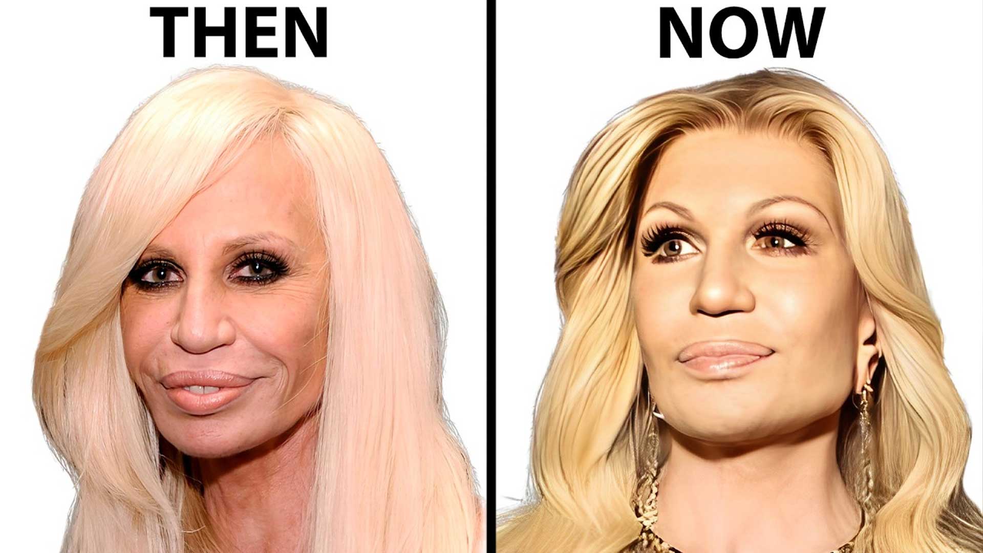 Donatella Versace plastic surgery