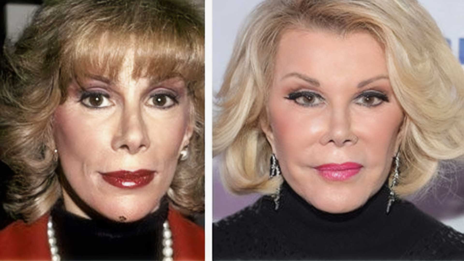 Joan Rivers plastic surgery before and after