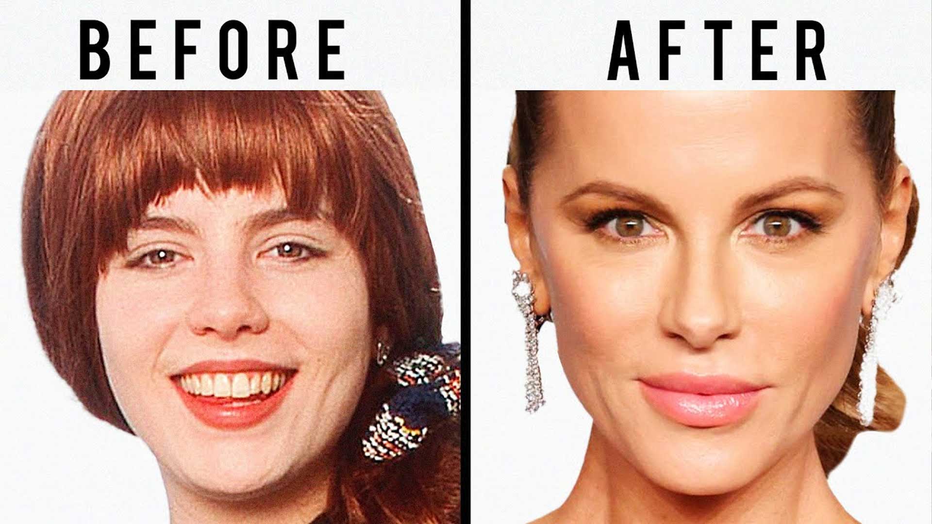 Kate Beckinsale plastic surgery before and after