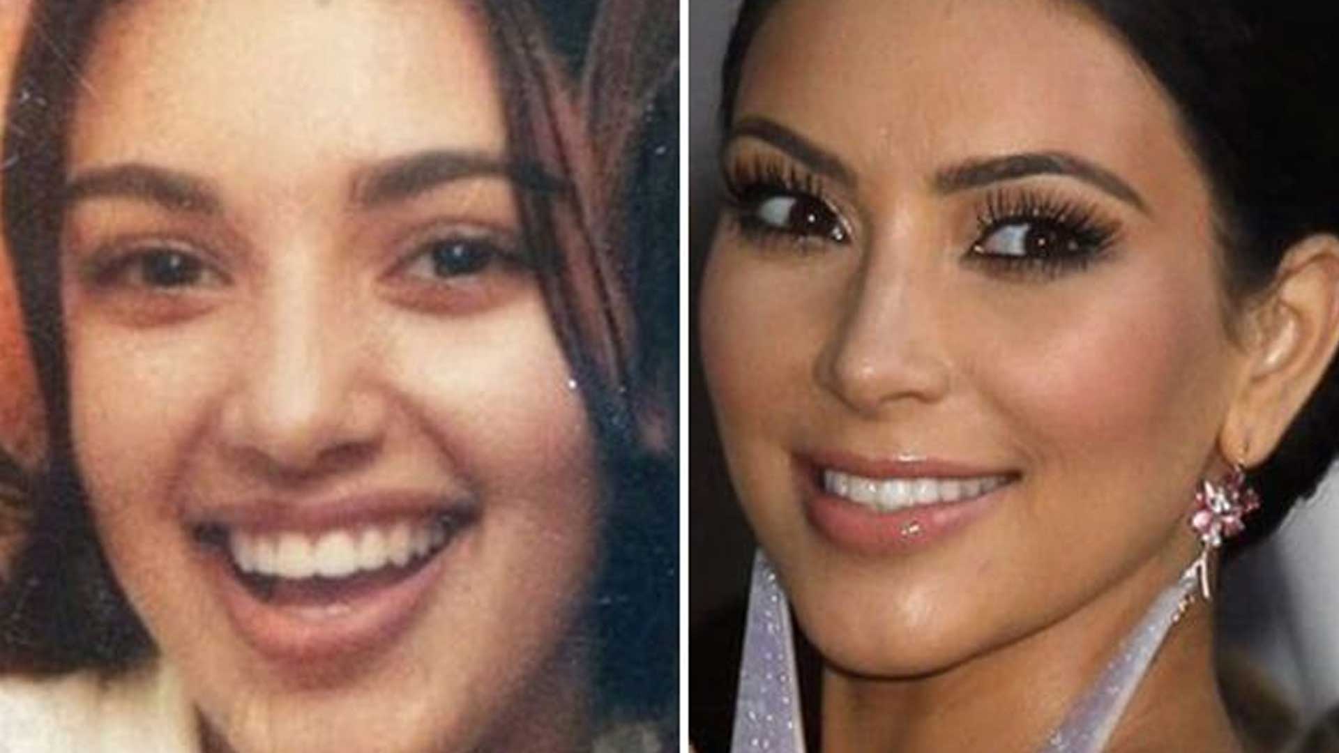 Kim Kardashian plastic surgery before and after