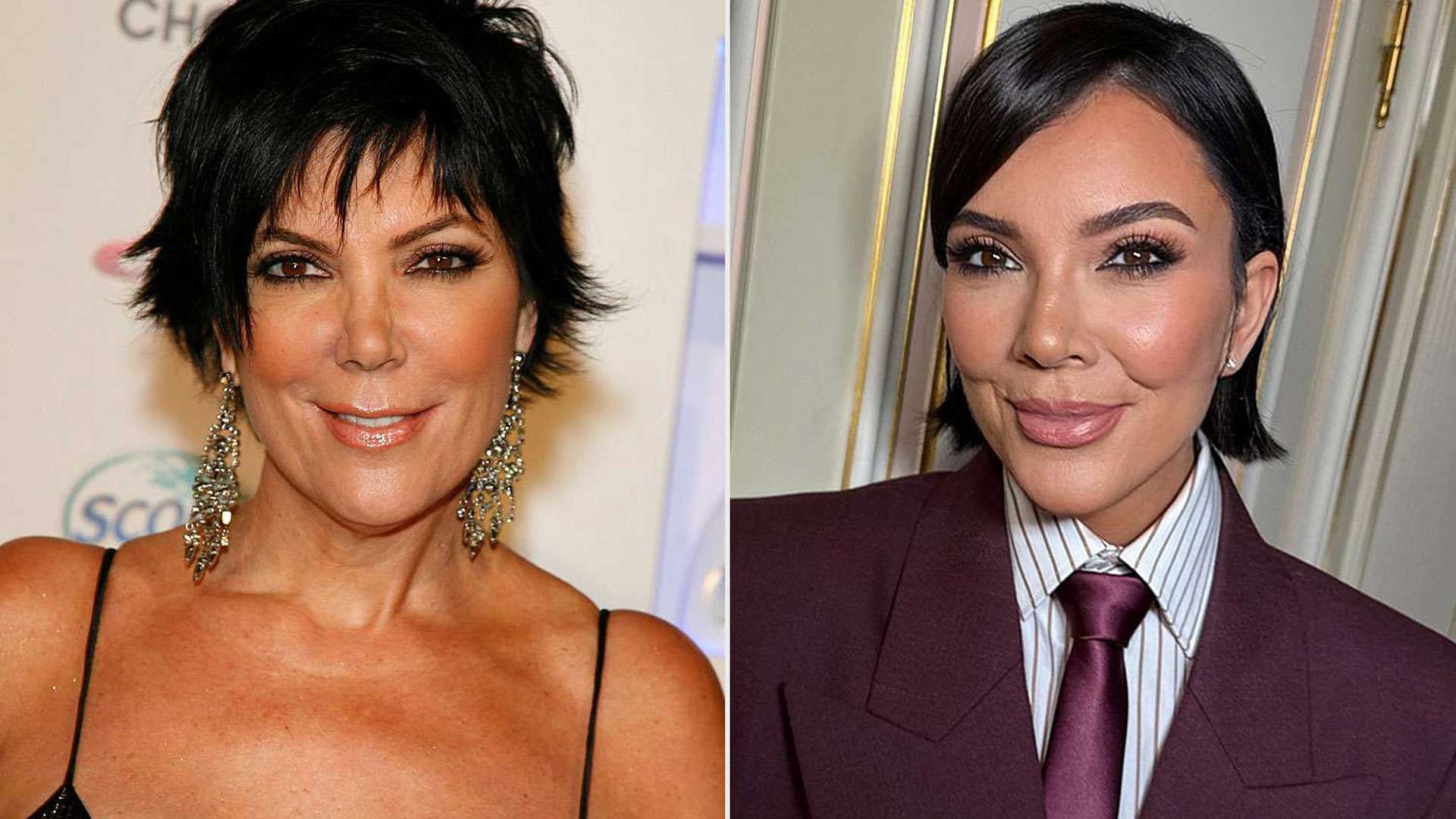 Kris Jenner plastic surgery before and after