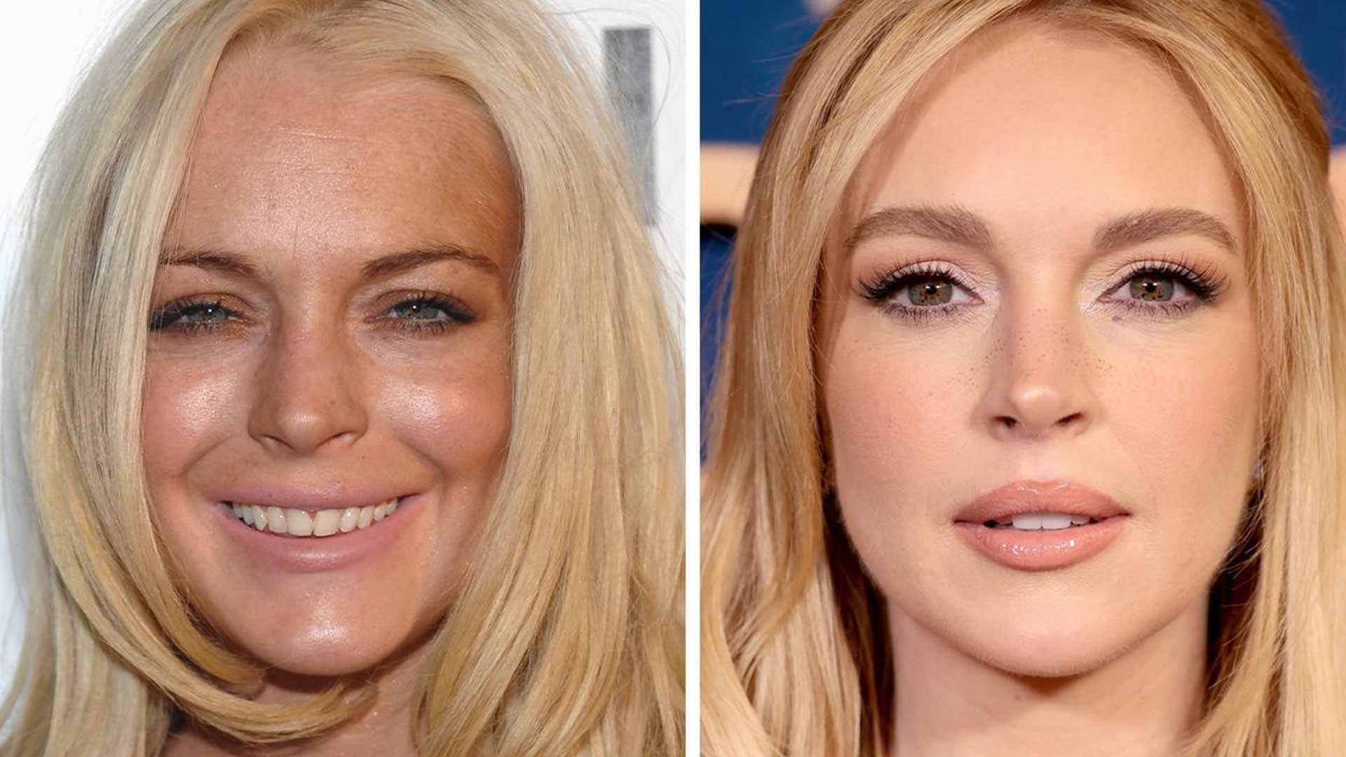 Lindsay Lohan plastic surgery before and after