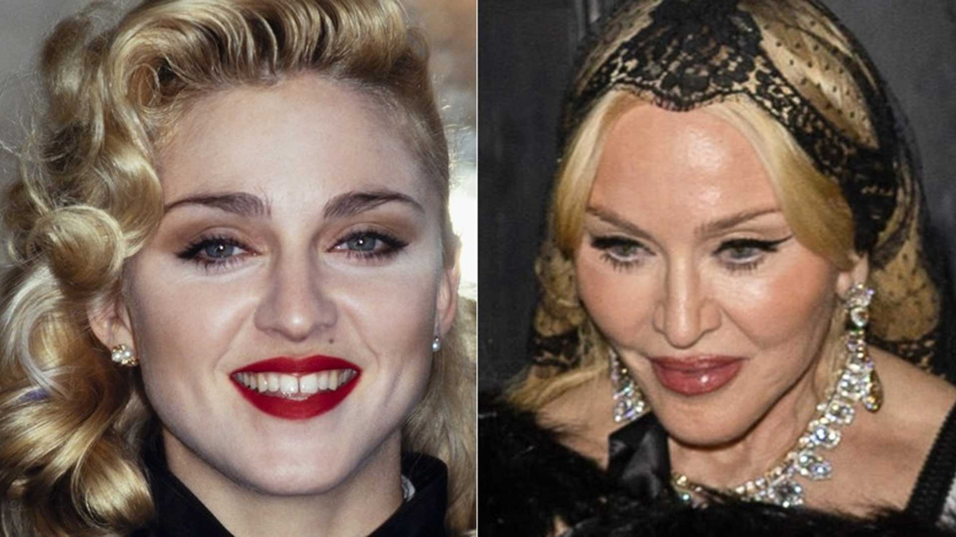 Madonna plastic surgery before and after