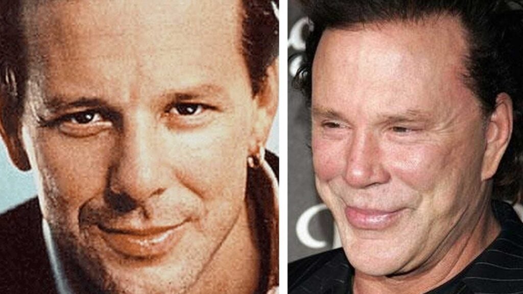 Mickey Rourke plastic surgery before and after
