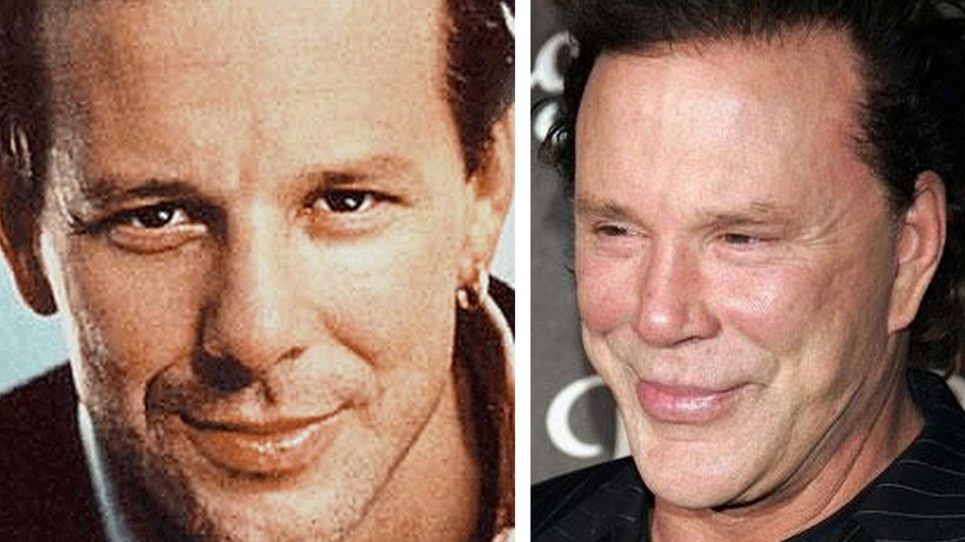 Mickey Rourke plastic surgery before and after