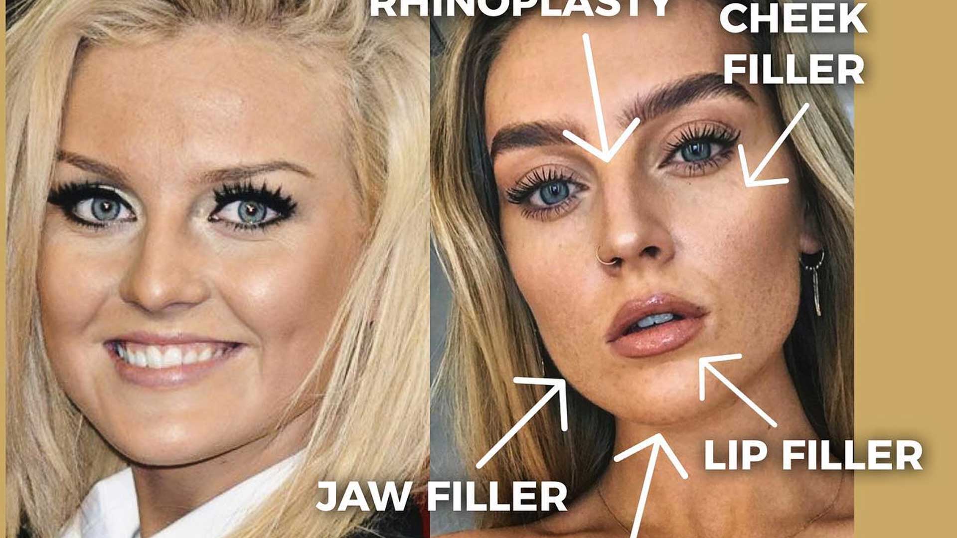 Perrie Edwards plastic surgery before and after