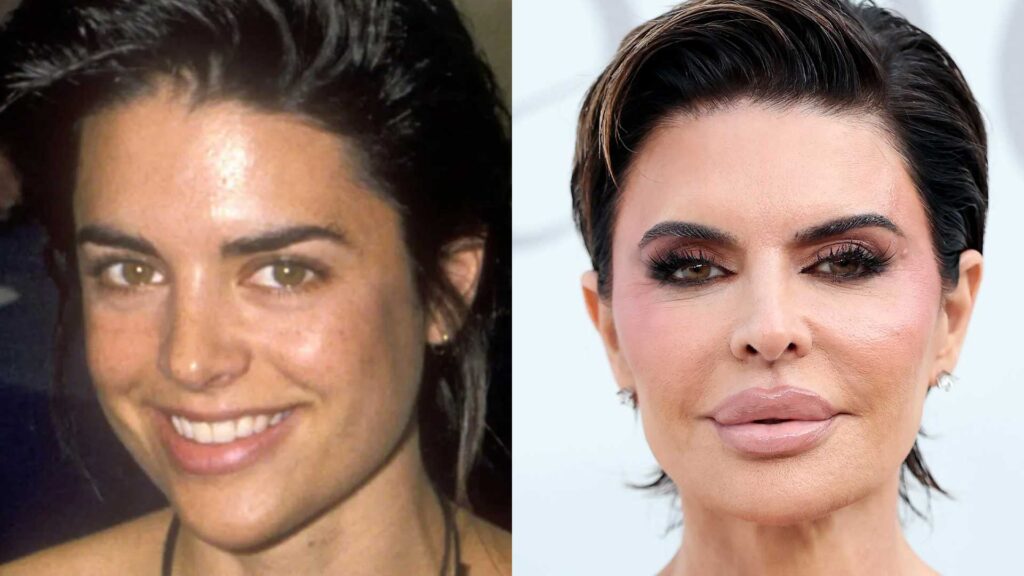 lisa rinna before plastic surgery